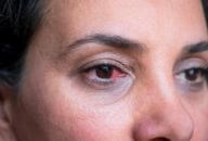 Imagem representativa de um olho humano, ilustrando a condição médica conhecida como canaliculite, que é a inflamação dos canais de drenagem da lágrima. A imagem destaca a área próxima ao canalículo lacrimal, onde a inflamação pode causar vermelhidão e irritação no canto interno do olho