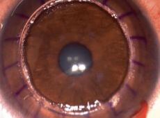 cirurgia ceratocone anel transplante de cornea 230