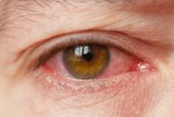 conjuntivite aguda olhos vermelhos grudados atestado prevencao tratamento 2 192