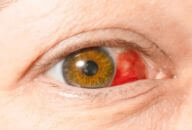 hemorragia subconjuntival no olho hiposfagma derrame ocular 192