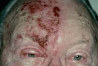 herpes zoster oftalmico no olho cobreiro grave risco visao 192