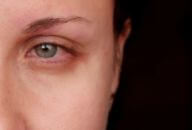 olho vermelho causas grave vista embacada serie 192