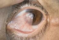 pterigio carne crescida esponjosa olho cirurgia retirar irritado 192