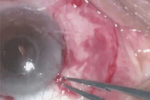 pterigio cirurgia transplante conjuntival enxerto com cola sem ponto sutura 300