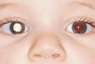 teste do olhinho reflexo vermelho alterado normal 192