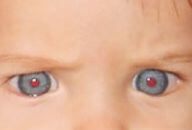 teste do olhinho reflexo vermelho alterado normal 2 192